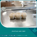 صورة واقعية عالية الجودة توضح شكل جسر الأسنان الخزفي الجاهز للتركيب لتعويض السن المفقود في عيادة أسنان فاخرة.
