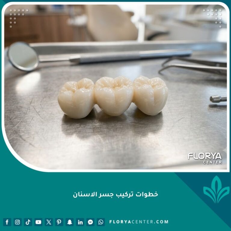 صورة واقعية عالية الجودة توضح شكل جسر الأسنان الخزفي الجاهز للتركيب لتعويض السن المفقود في عيادة أسنان فاخرة.