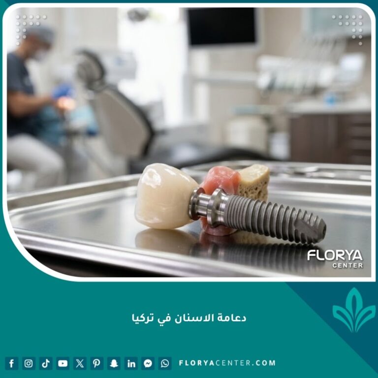 صورة مقربة توضح شكل دعامة الأسنان الحديثة وتركيبها فوق الزرعة، ضمن تجهيزات عيادة أسنان متطورة في تركيا.
