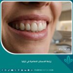 ابتسامة مثالية تبرز نتائج زراعة الأسنان الأمامية التجميلية مع تيجان شفافة وتجميل دقيق للثة.