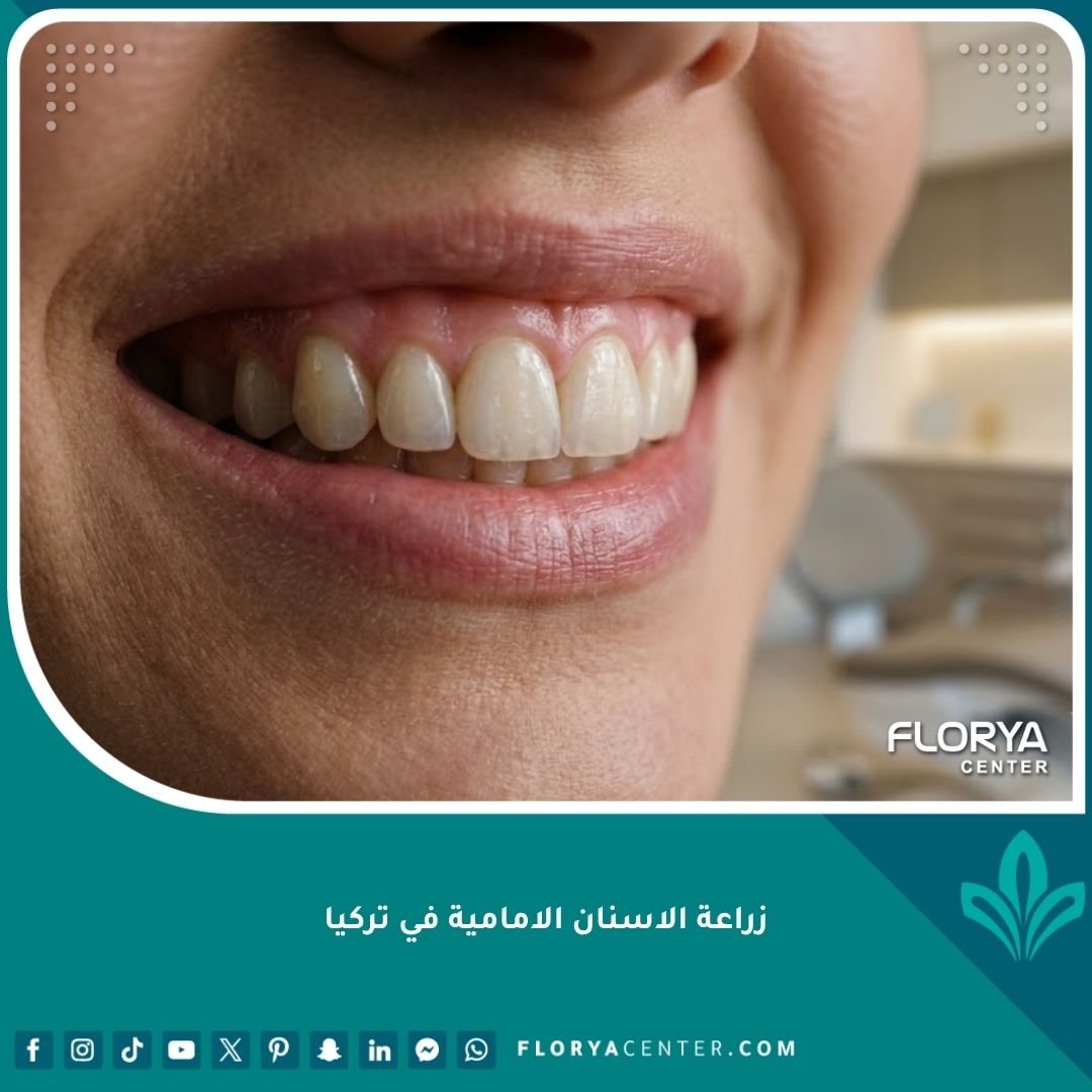 ابتسامة مثالية تبرز نتائج زراعة الأسنان الأمامية التجميلية مع تيجان شفافة وتجميل دقيق للثة.