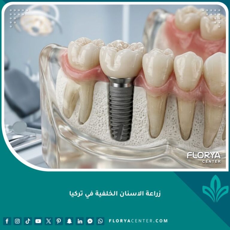 صورة مقربة عالية الدقة توضح متانة وقوة زراعة الاسنان الخلفية باستخدام غرسات التيتانيوم لتحمل قوى المضغ.
