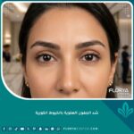 صورة مقربة تبرز النتيجة الفورية المذهلة بعد شد الجفون العلوية بالخيوط الكورية لعيون شابة ومشرقة بدون جراحة.