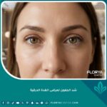صورة مقربة تظهر جمال وتناسق العيون بعد نجاح عملية شد الجفون لمرضى الغدة الدرقية وعلاج جحوظ العين.