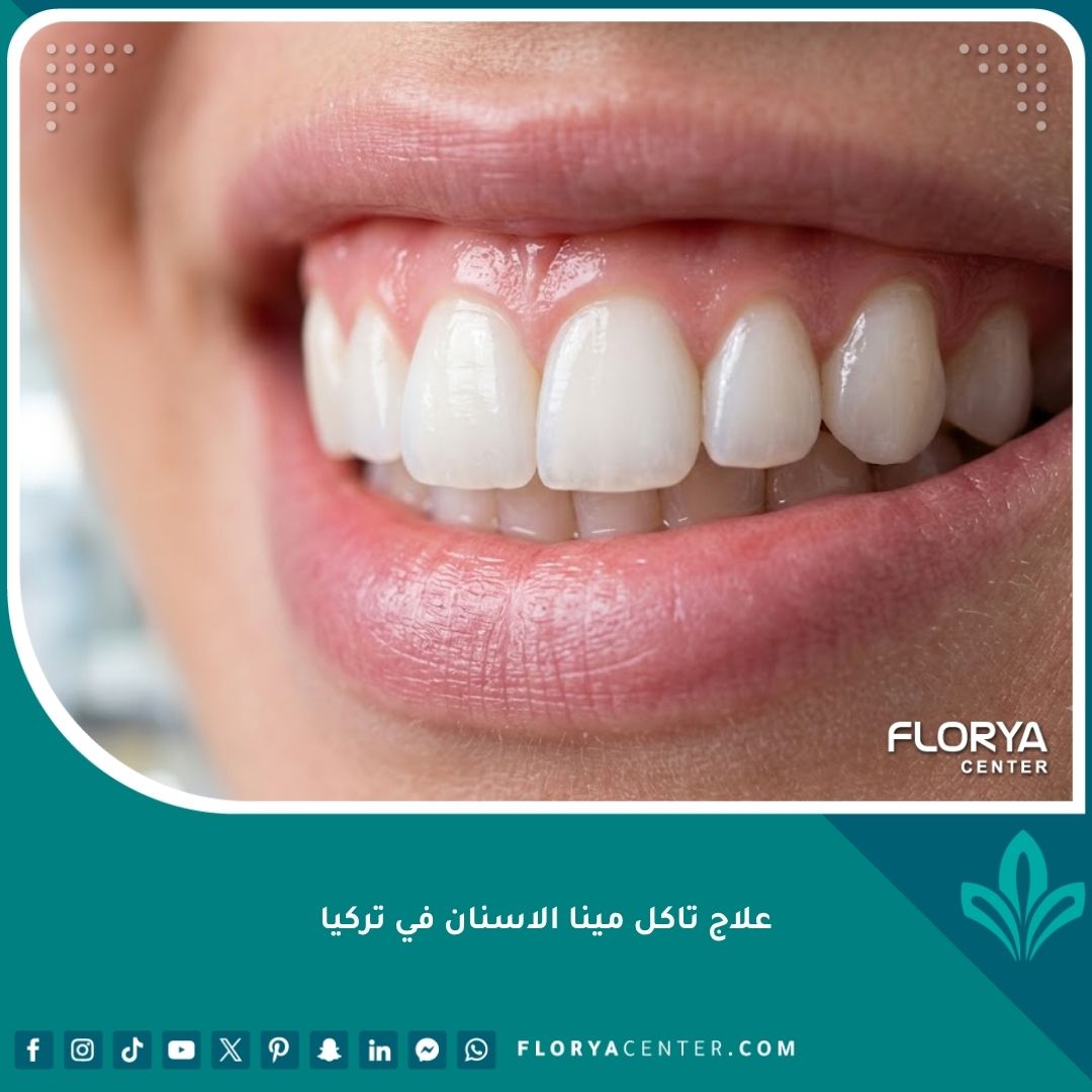 ابتسامة صحية ومشرقة تعكس نجاح علاج تآكل مينا الأسنان في تركيا والتخلص من الحساسية.