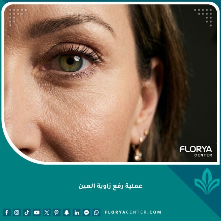 صورة سينمائية لامرأة ذات عيون مرفوعة عند الزاوية الخارجية بعد إجراء عملية ناجحة لرفع زاوية العين، تُظهر مظهراً مشرقاً وشاباً.