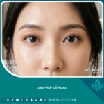صورة مقربة لعينين واسعتين وجذابتين بعد عملية شد ثنية الجفن المزدوج، توضح النتيجة التجميلية وتسهيل وضع المكياج.