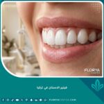 ابتسامة هوليوود مثالية بعد تركيب فينير الاسنان في تركيا للحصول على أسنان بيضاء ومشرقة.