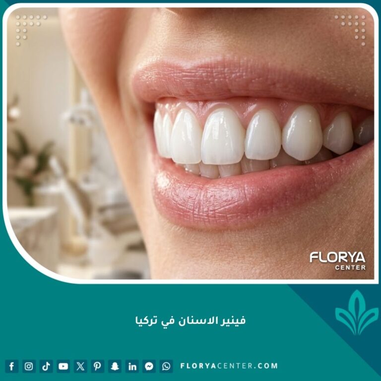 ابتسامة هوليوود مثالية بعد تركيب فينير الاسنان في تركيا للحصول على أسنان بيضاء ومشرقة.
