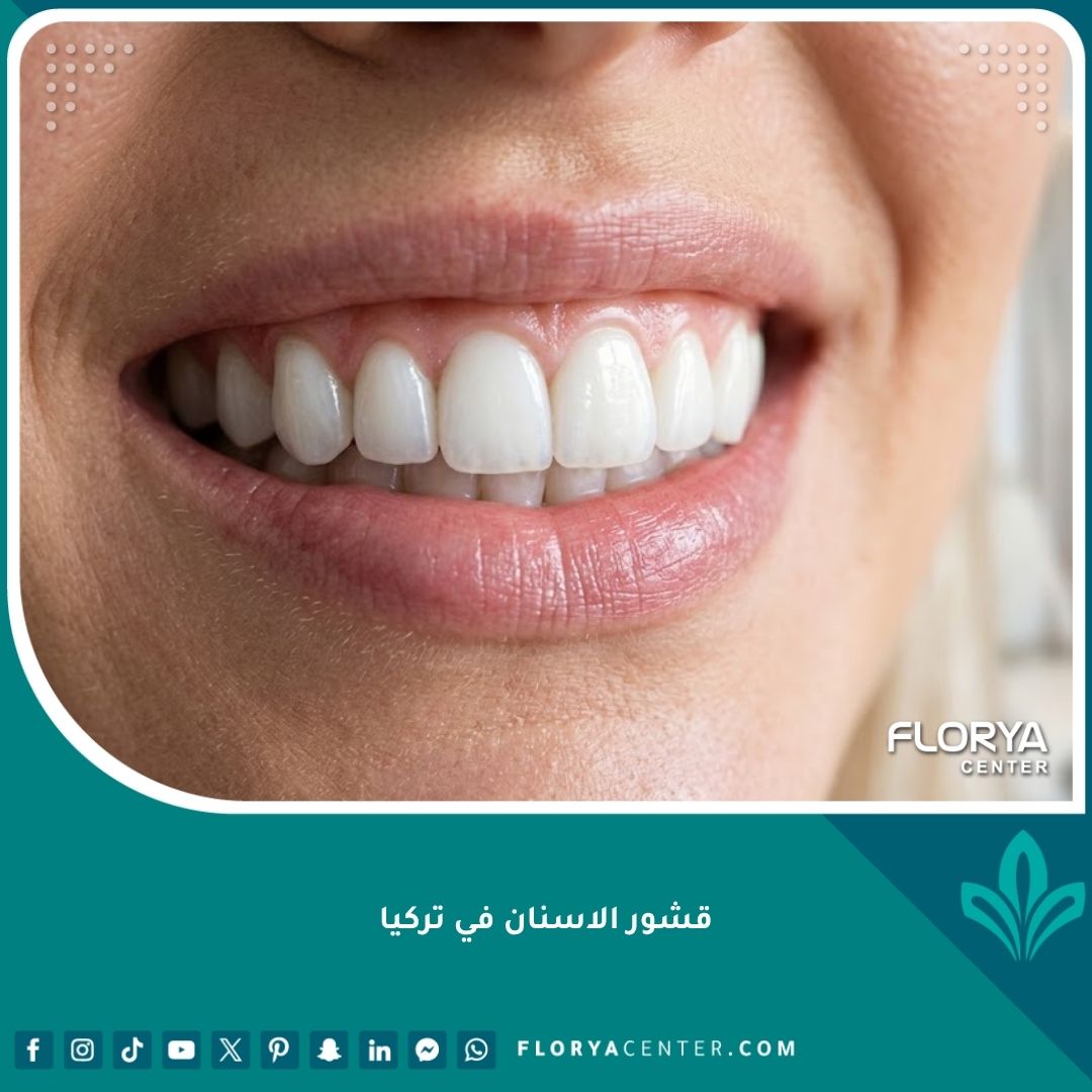 ابتسامة ناصعة البياض تبرز جمال ومثالية قشور الاسنان في تركيا.