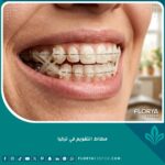 صورة قريبة ومقربة تبرز مطاط التقويم الشفاف المستخدم في تقويم الأسنان لتصحيح العضة بوضوح.