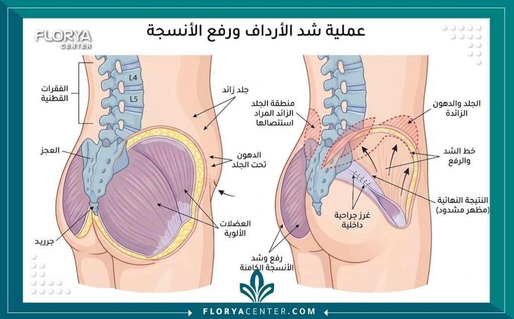 إزالة الجلد الرخو من الأرداف 2 رسم توضيحي طبي يشرح تشريحياً كيفية قص الجلد المترهل وشد الأرداف جراحياً للحصول على مؤخرة مشدودة.