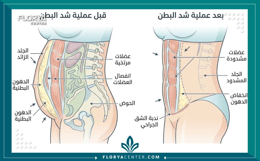 رسم توضيحي طبي دقيق يشرح خطوات عملية شد البطن وكيفية إزالة الجلد الزائد والترهلات وشد العضلات.