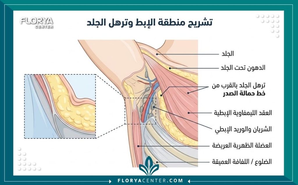 إزالة ترهلات أسفل الإبط 2 رسم توضيحي طبي يوضح تشريح منطقة أسفل الإبط والكتلة الدهنية المسببة لترهلات حمالة الصدر.