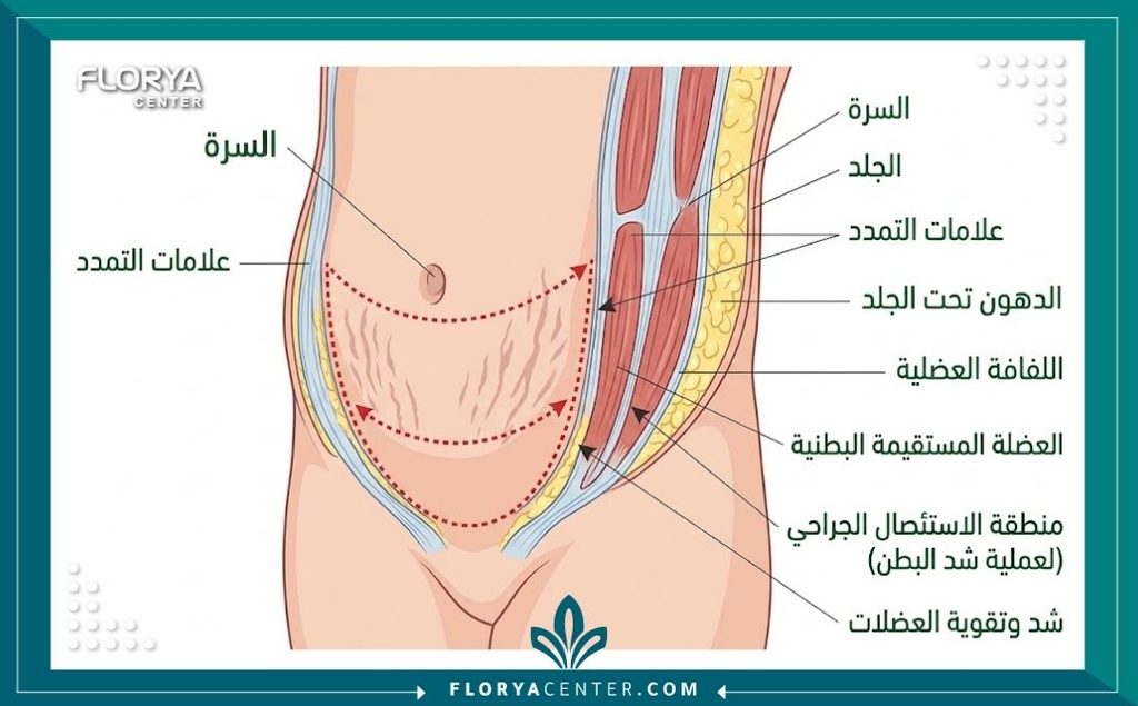 إزالة تشققات البطن العميقة مع الشد 2 رسم توضيحي طبي يوضح تشريح طبقات الجلد وكيفية استئصال التشققات الموجودة تحت السرة بالكامل جراحياً.