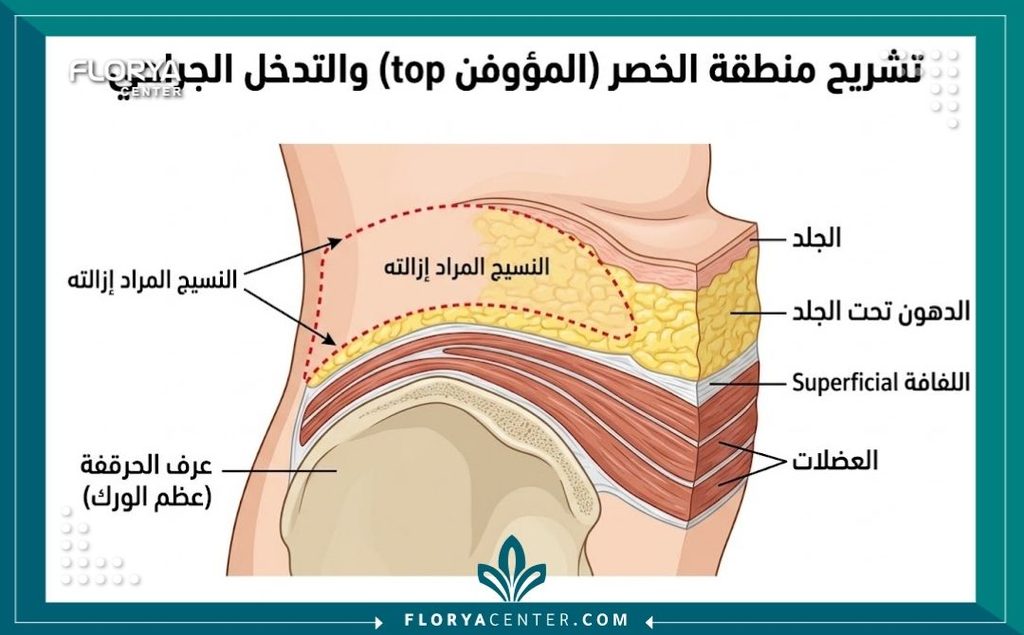 رسم توضيحي طبي لتشريح منطقة الخواصر يوضح تراكم الدهون وطيات الجلد الجانبية مع خطوط الإزالة الجراحية.