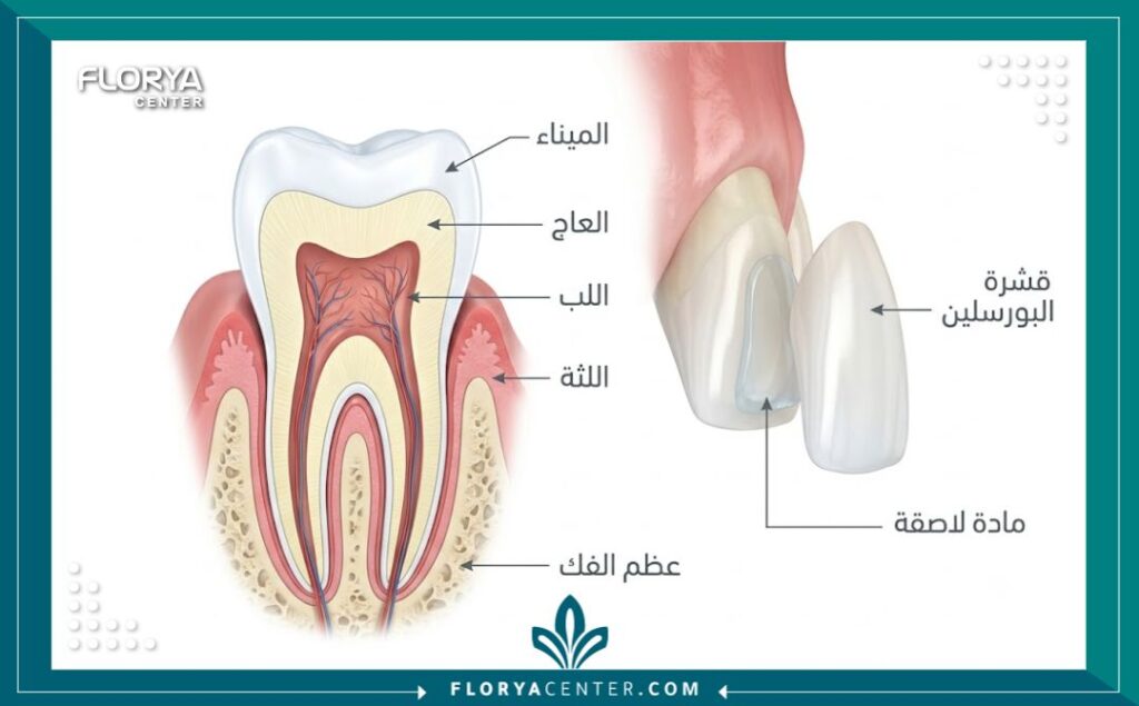 رسم توضيحي طبي يوضح تشريح السن وتركيب قشور الفينير للحصول على ابتسامة المشاهير.