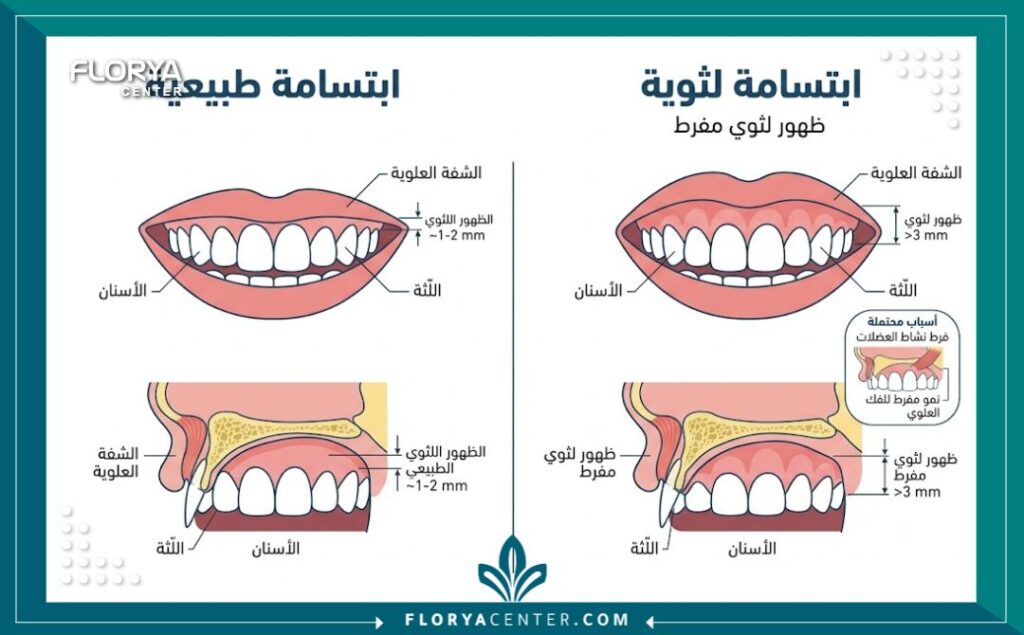رسم توضيحي طبي لتشريح الفم يقارن بين الابتسامة الطبيعية والابتسامة اللثوية وأسباب ظهور اللثة.