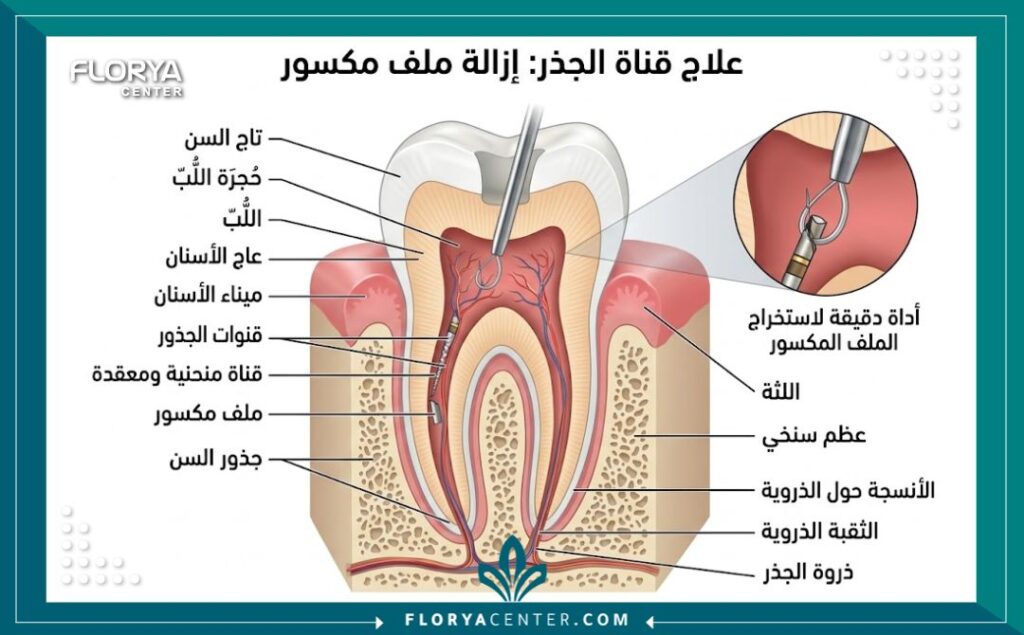 اخصائي علاج عصب في تركيا 2 رسم توضيحي طبي يشرح تشريح جذور الأسنان المعقدة وكيفية استخراج الأدوات المكسورة من العصب