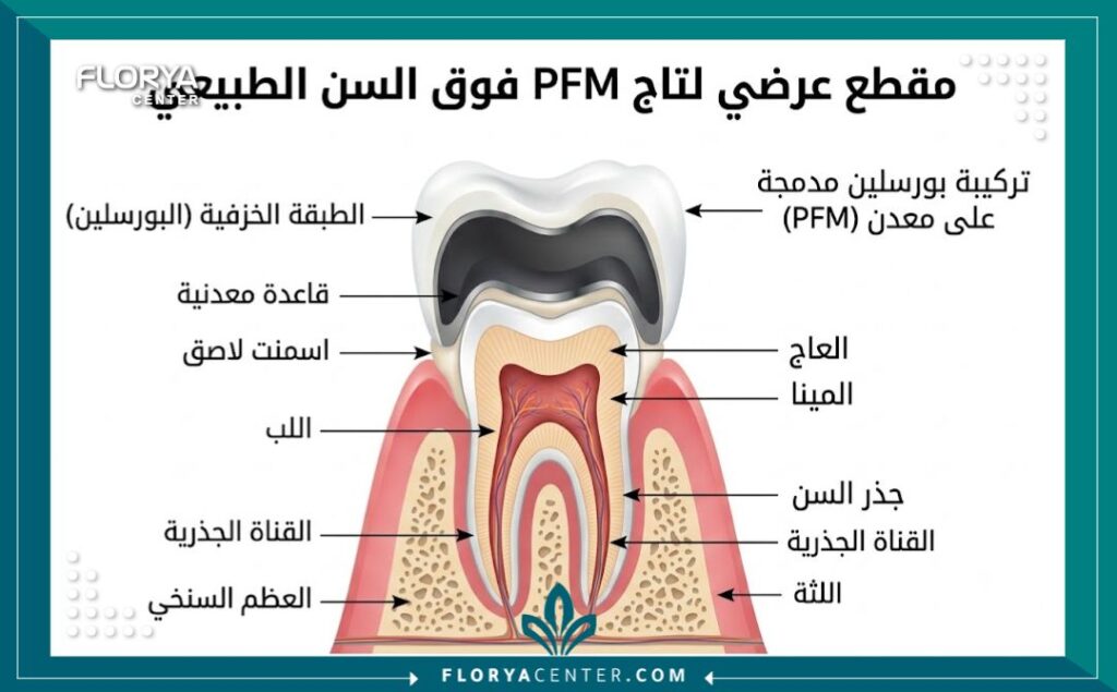 رسم توضيحي لطبقات البورسلين والمعدن التي تتكون منها ارخص تلبيسة اسنان في تركيا.