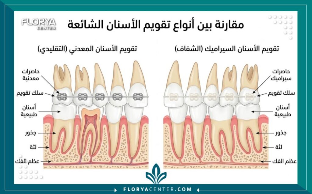 ارخص دكتور تقويم اسنان في تركيا 2 رسم توضيحي طبي لأنواع تقويم الأسنان المعدني والخزفي، لمساعدة الباحثين عن ارخص اسعار تقويم الاسنان في تركيا.