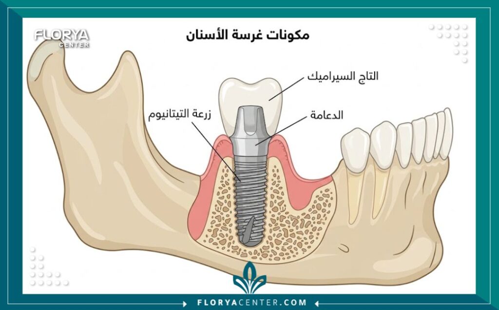 ارخص دولة لزراعة الاسنان 2 رسم توضيحي لأجزاء زرعة الأسنان التي تشمل التاج والدعامة ومسمار التيتانيوم في الفك.
