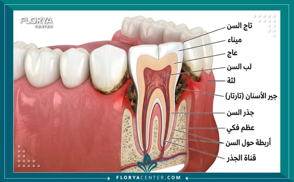 ازالة جير الاسنان الاسود في تركيا 2 رسم توضيحي طبي يوضح أماكن تراكم جير الأسنان الأسود الصلب خلف الأسنان السفلية وتحت اللثة.