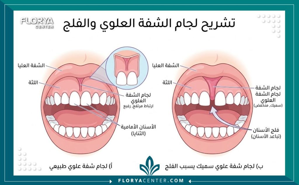 رسم توضيحي طبي دقيق يشرح تشريح لجام الشفة العلوية وكيف يتسبب في ظهور الفلجة أو الفراغ بين الأسنان الأمامية.