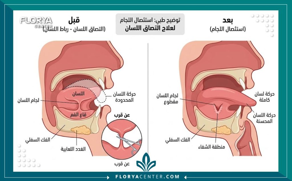 رسم توضيحي طبي لتشريح الفم يوضح حالة اللسان المربوط قبل وبعد جراحة استئصال لجام اللسان.