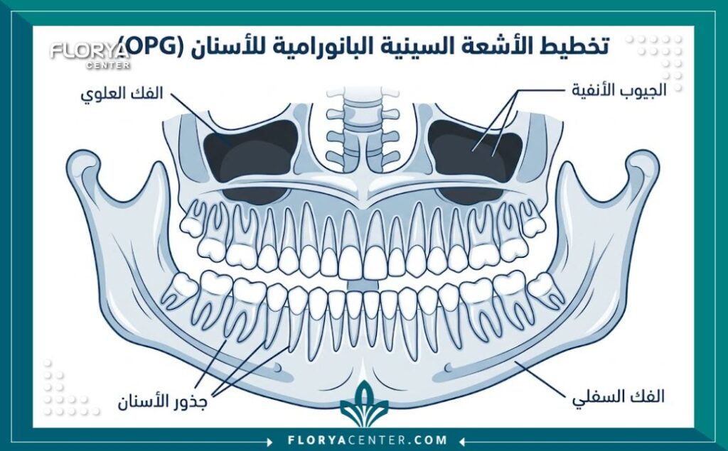رسم تخطيطي تشريحي يوضح أجزاء الفك والأسنان الموضحة في فحص أشعة البانوراما للأسنان.