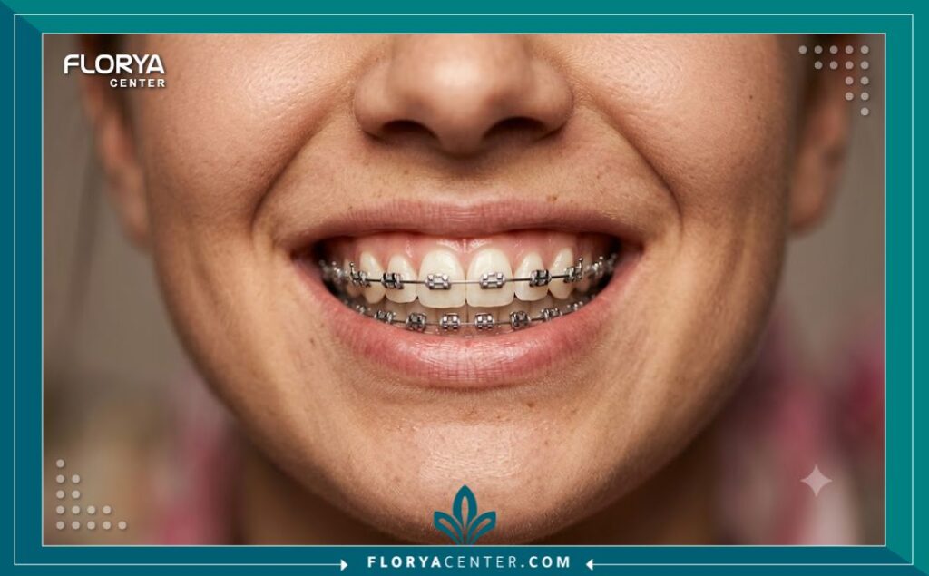 علاج اعوجاج الأسنان بالتقويم المعدني بأسعار اقتصادية ونتائج جمالية مضمونة.