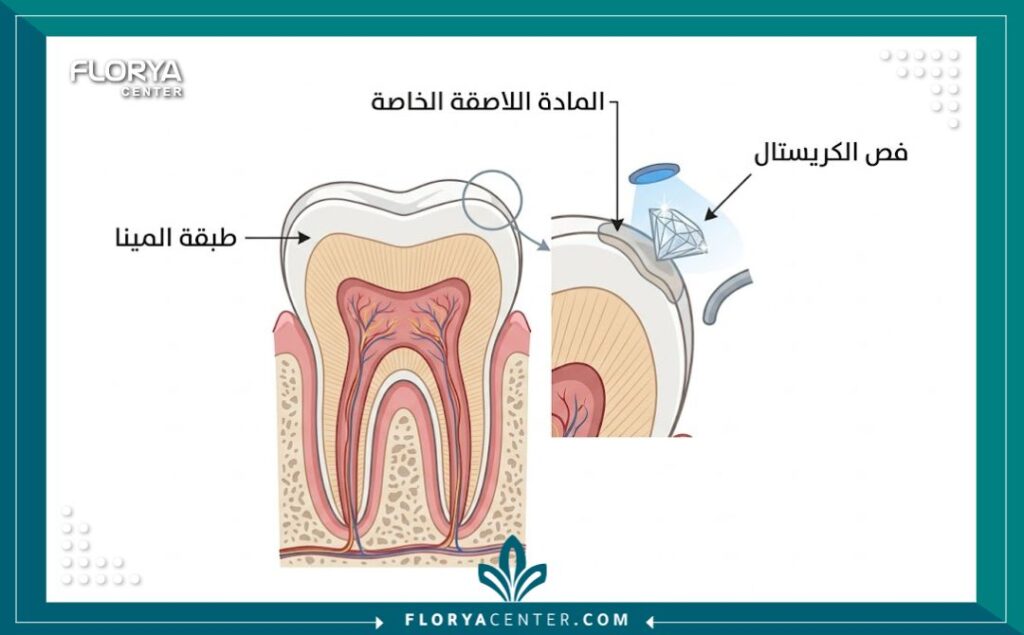 رسم تخطيطي توضيحي لخطوات تركيب الدايموند للأسنان بأمان فوق طبقة المينا دون حفر.