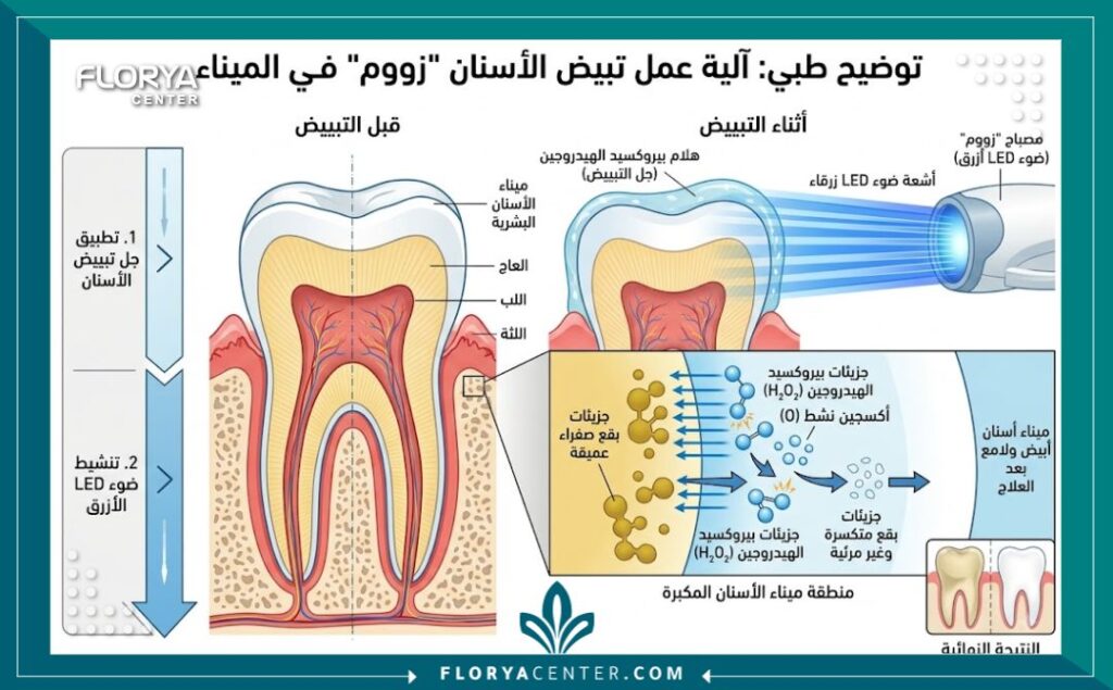اسعار تبييض الاسنان بالزوم 2 رسم توضيحي يوضح آلية عمل تقنية تبييض الأسنان بالزوم وتأثير الضوء الأزرق على المينا