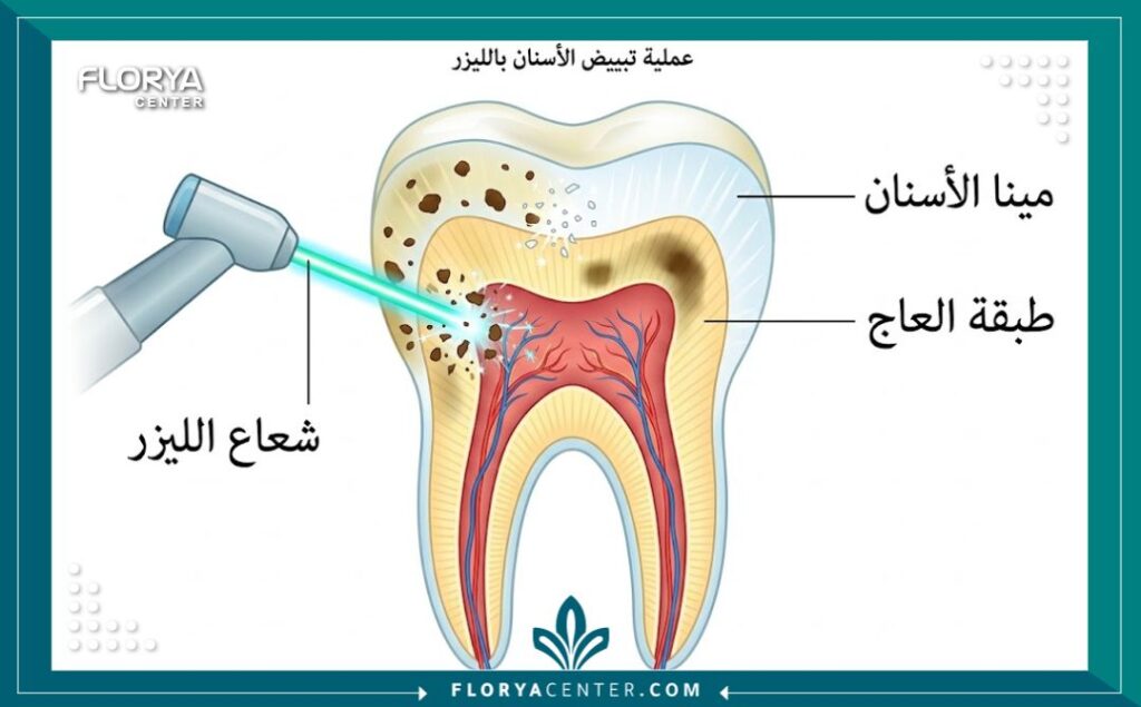 رسم تخطيطي توضيحي لكيفية عمل شعاع الليزر في اختراق طبقة مينا الأسنان وتفكيك التصبغات.