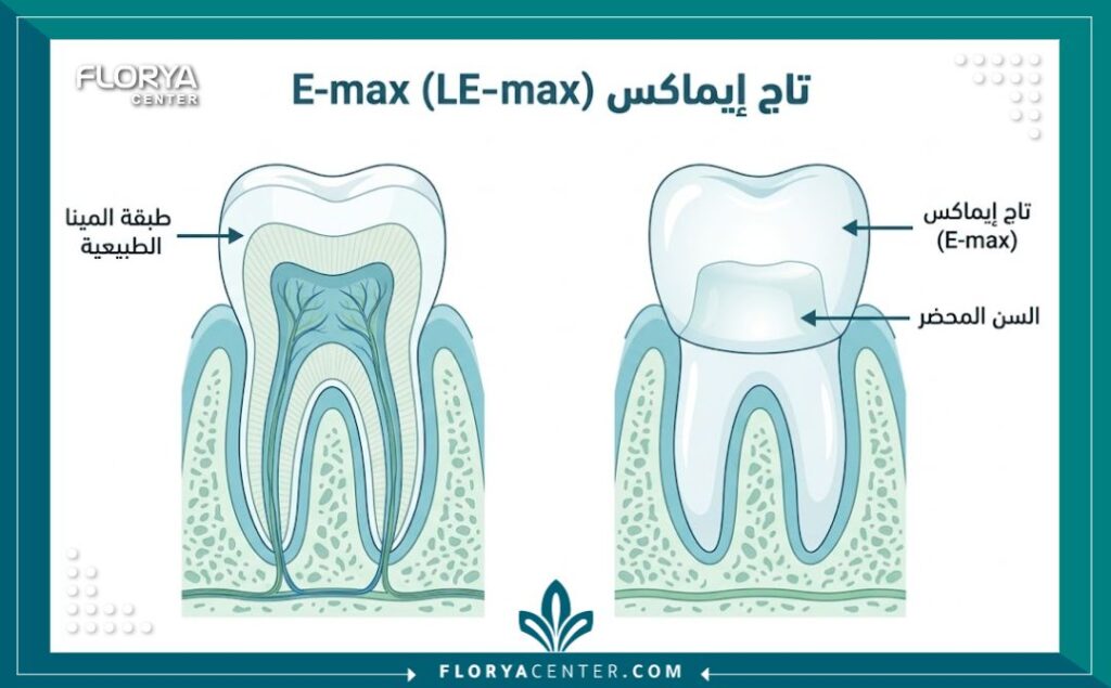 رسم توضيحي تشريحي يبين طريقة تركيب تاج الايماكس فوق السن المحضر.