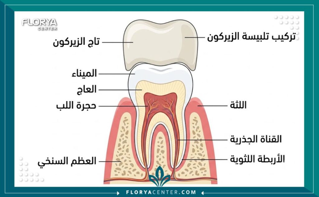 رسم توضيحي يوضح تشريح وخطوات تركيبة تاج الزيركون للأسنان مع المكونات بالتفصيل