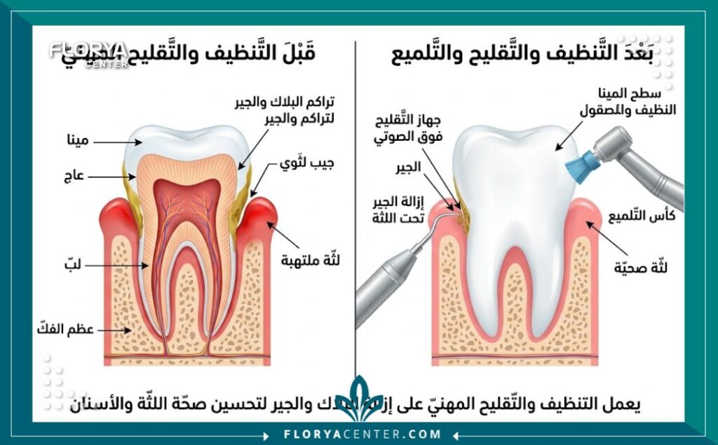 اسعار تنظيف الاسنان بتركيا 2 مخطط طبي يوضح طريقة إزالة الجير والترسبات وآلية تنظيف الأسنان في تركيا