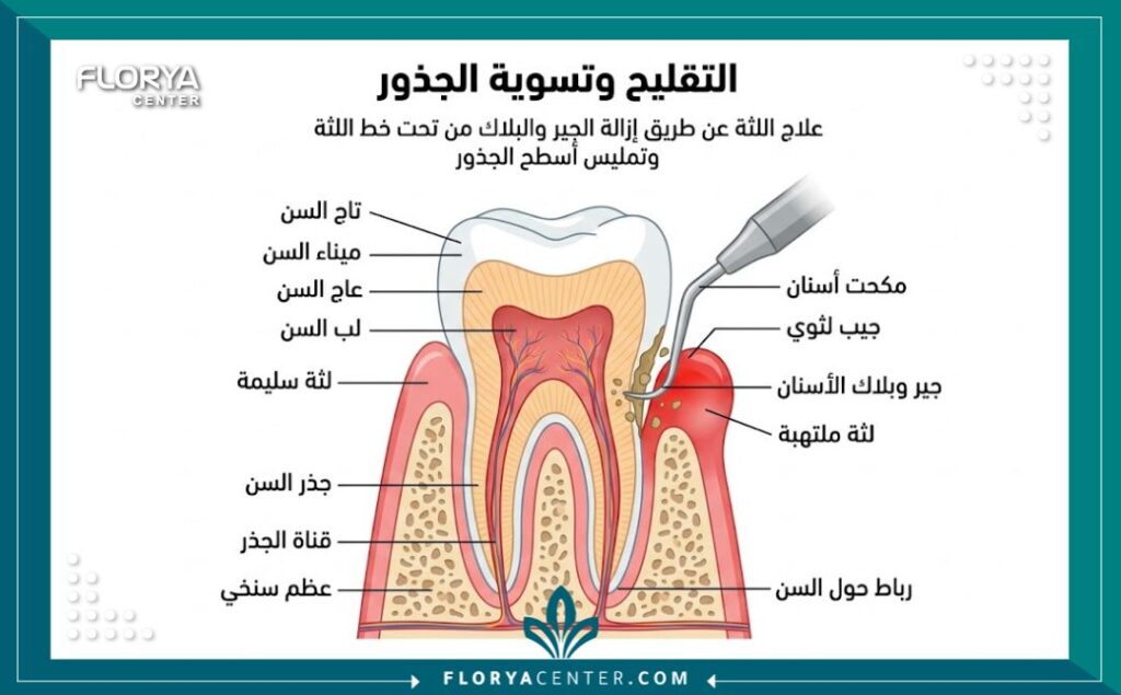 اسعار تنظيف اللثة العميق 2 رسم توضيحي طبي لعملية كشط الجذور تحت مستوى اللثة لإزالة الجير وعلاج الجيوب اللثوية.