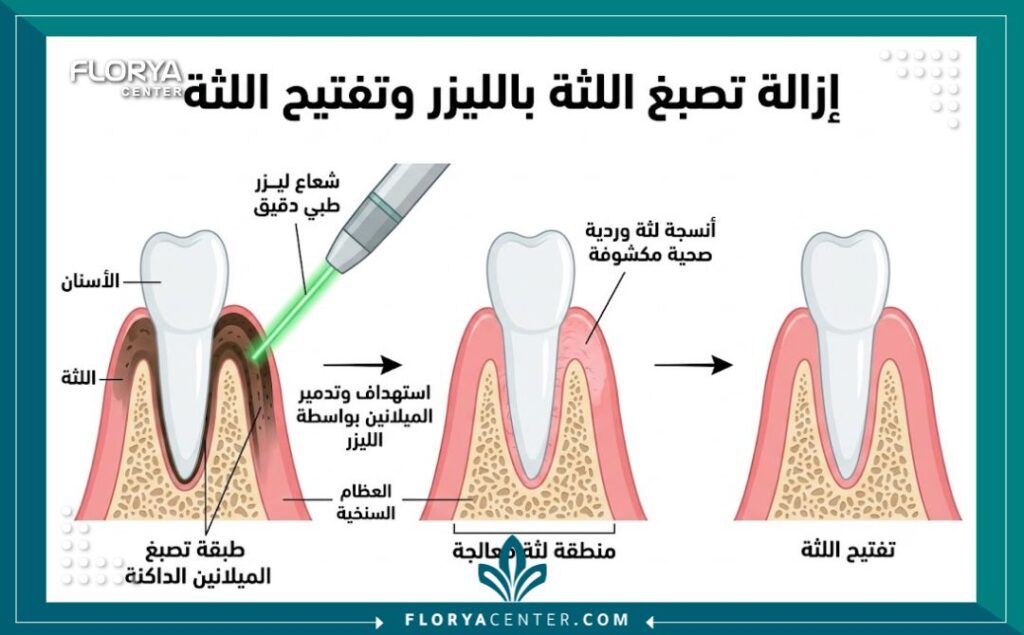 رسم تخطيطي طبي يوضح آلية عمل الليزر في إزالة تصبغات اللثة وتوريدها.