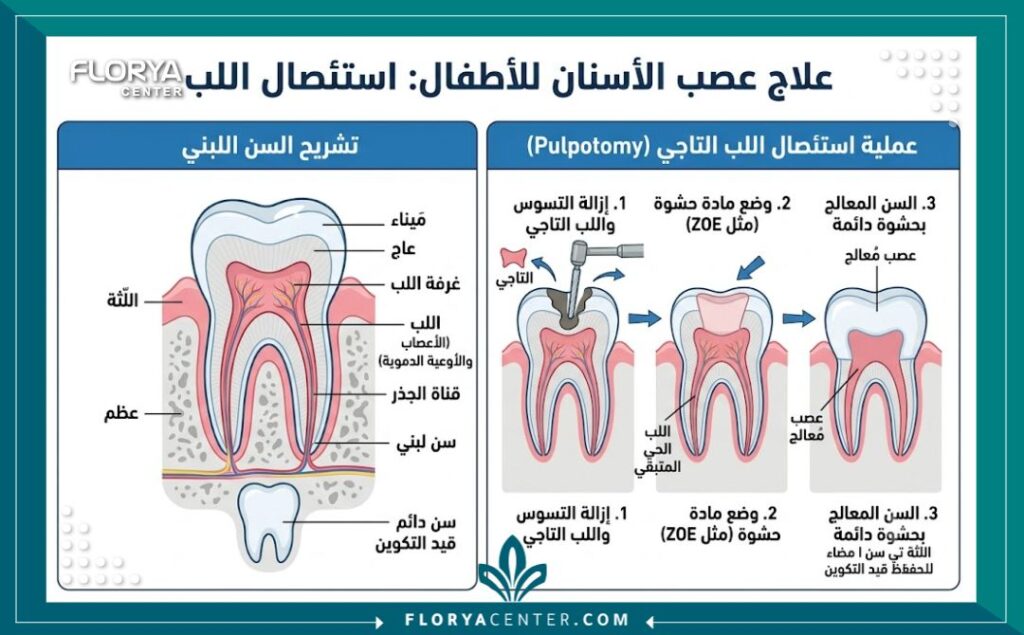 رسم توضيحي طبي يشرح تشريح السن اللبني وكيفية إجراء علاج وحشو العصب للأطفال.