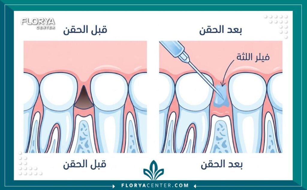 مخطط طبي توضيحي يعرض كيفية عمل حقن الفيلر للثة وملء الفراغات المثلثة السوداء بين الأسنان.
