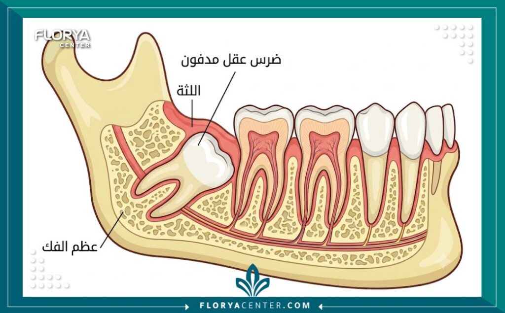 رسم توضيحي يظهر تشريح ضرس العقل المدفون أسفل العظم واللثة