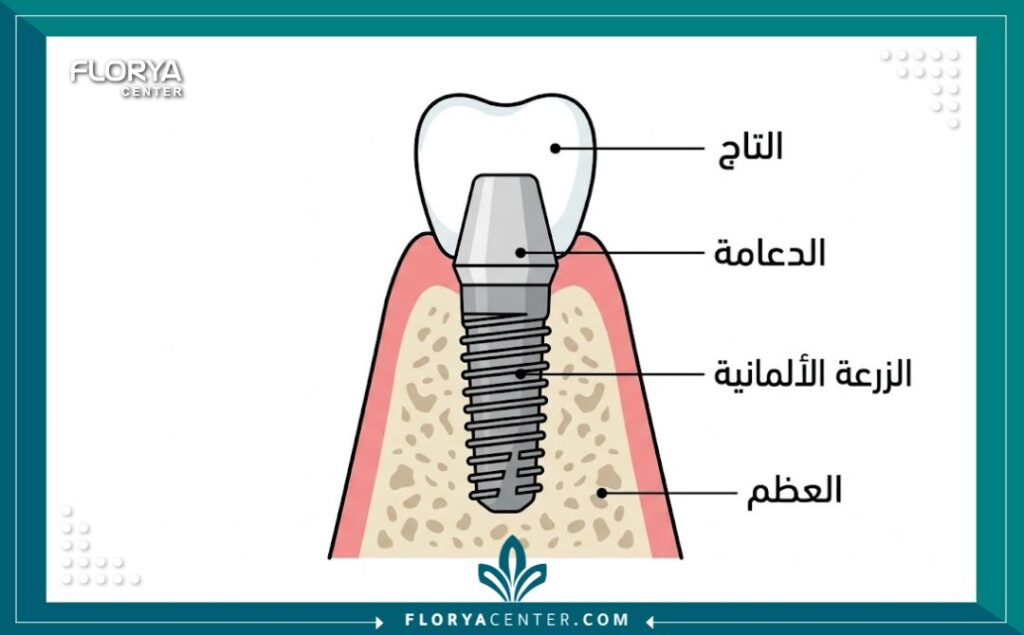 رسم توضيحي لتشريح زراعة الأسنان الألمانية وأجزاء الزرعة في العظم