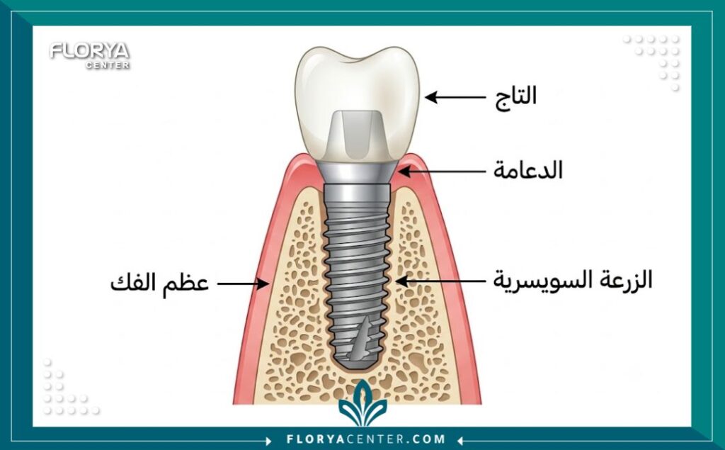 تشريح زرعة الأسنان السويسرية ومكوناتها من التاج والدعامة والجذر