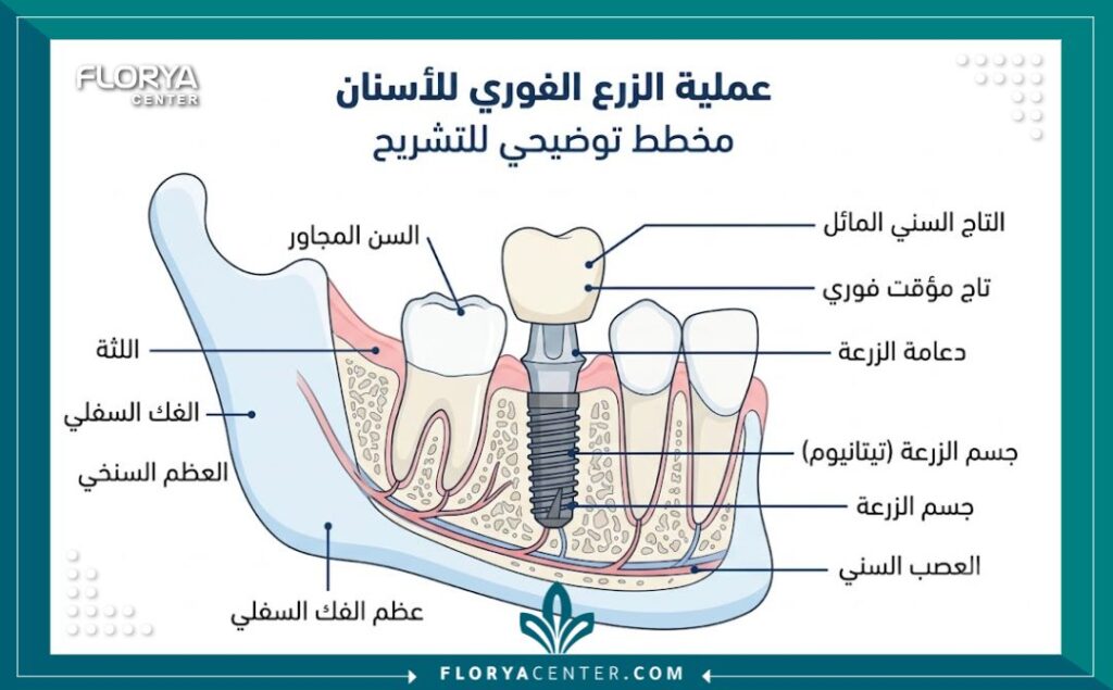 رسم تخطيطي توضيحي لمراحل زراعة الأسنان الفورية وتثبيت الغرسة والتاج في العظم.