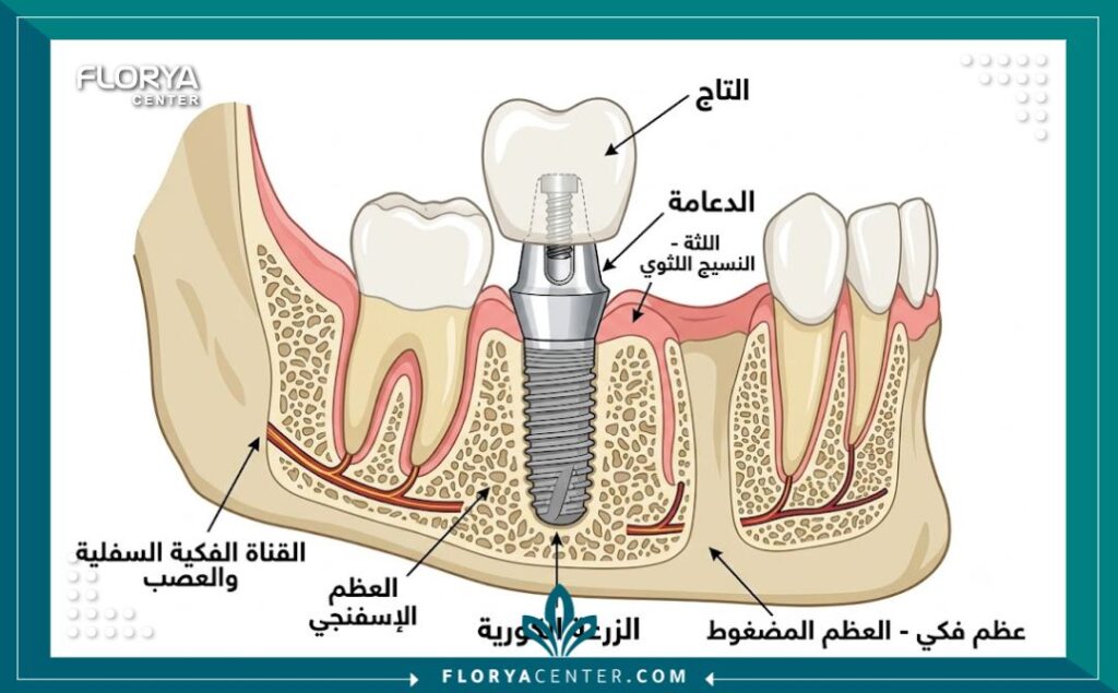 رسم تخطيطي يوضح أجزاء الزرعة الكورية وتركيب زرعات الأسنان في عظم الفك