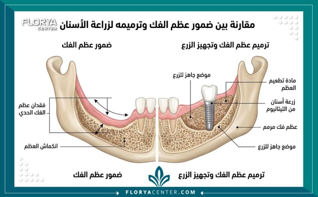 اسعار زراعة العظم للاسنان في تركيا 2 اسعار زراعة العظم للاسنان في تركيا 1 - اسعار زراعة العظم للاسنان في تركيا فشل زراعة الأسنان يبدأ من إهمال تآكل الفك. يحدد سمك العظم نجاح الإجراء. تمثل اسعار زراعة العظم للاسنان في تركيا (Dental Bone Grafting Prices) استثماراً ذكياً. يقدم مركز فلوريا المعيار الذهبي لترميم الفكين.