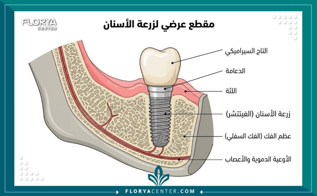 اسعار طب الاسنان في تركيا 2 مخطط توضيحي لأجزاء زراعة الأسنان وتأثير التقنيات على اسعار طب الاسنان في تركيا.