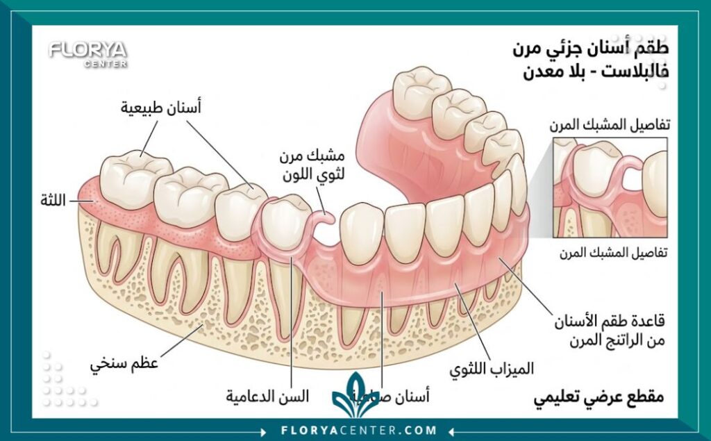 رسم توضيحي طبي يوضح تشريح وكيفية ثبات طقم الأسنان المرن فالپلاست على اللثة بمرونة وبدون مشابك معدنية مزعجة.