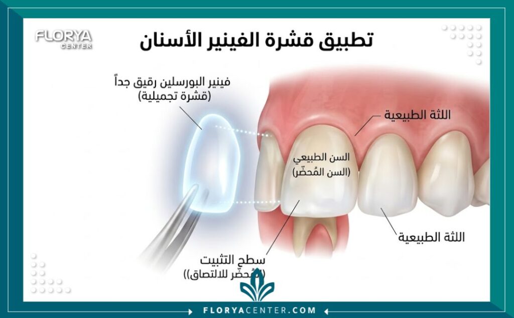 رسم توضيحي طبي يوضح كيفية تركيب قشور الفينير واللومينير على الأسنان